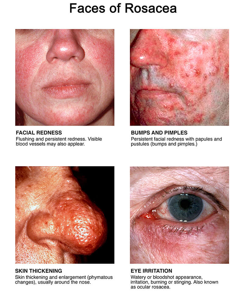 All About Rosacea